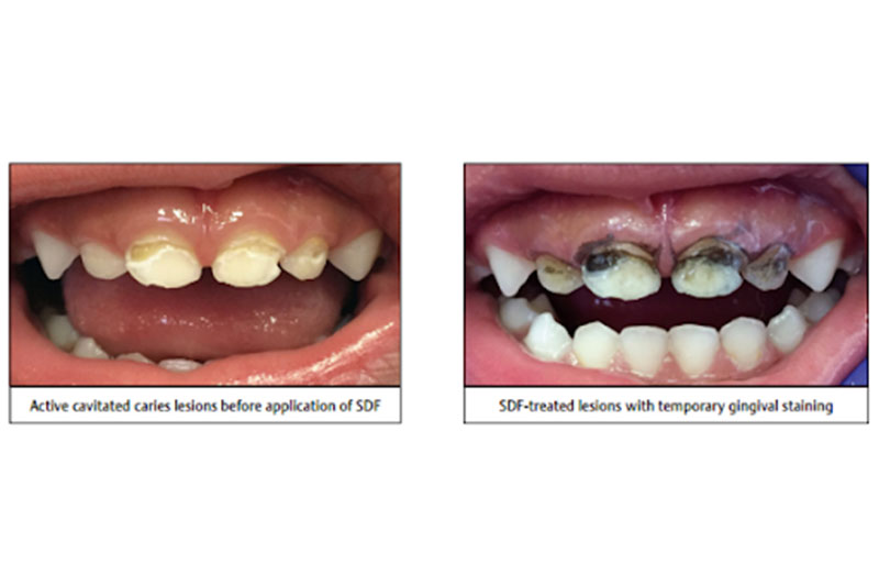 Fluoride Treatments in Germantown